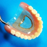 Full Denture Clear Palate with Gold Mesh