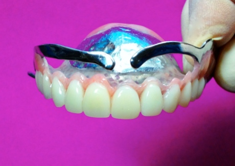 Sturdy new Hybrid Design Dentures with Nobilium metal wings for patients with bulky gingival. Excellent Aesthetic look with perfect fit and enhanced function.