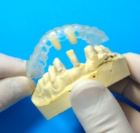 Essix Retainer with replacement teeth (1)
