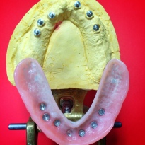 Finished Full Upper overdenture implant reinforced with Nobilium mesh to avoid breaking [Step 2 in wax] (Micro Ball Attachments)