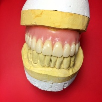 Finished Full Upper overdenture implant reinforced with Nobilium mesh to avoid breaking [Step 3 Finished Case] (Micro Ball Attachments)