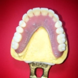Finished Full Upper overdenture implant reinforced with Nobilium mesh to avoid breaking [Step 3 Finished Case inside] (Micro Ball Attachments)
