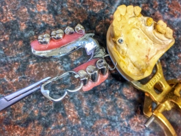 White Gold Partial Denture in Framework and Attachments for Implant