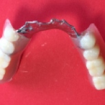 Finished overdenture partial