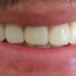 After [Duplicate New Overdenture]